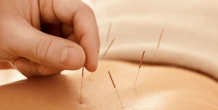 akupunktura proti kajenju